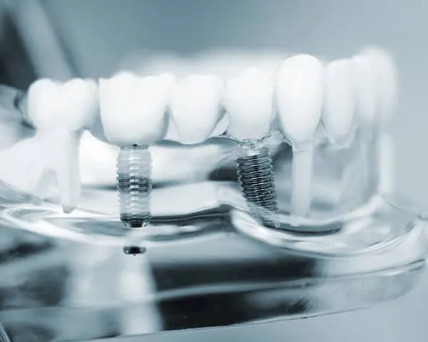 683720425a142599bade098f_implants-in-a-day_11zon