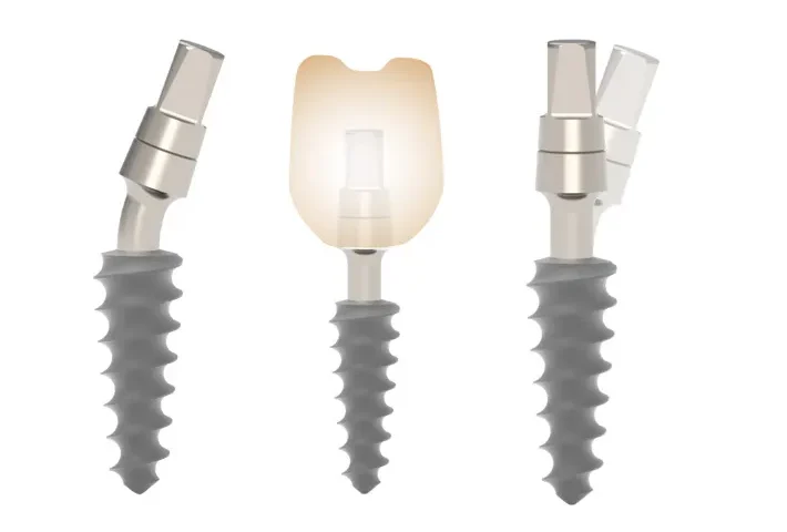 خرید ایمپلنت مونوبلاک (Monoblock Implant)